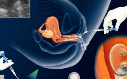 优势尽显，缺陷难避？解析：泰国第三代试管婴儿的优点和缺点